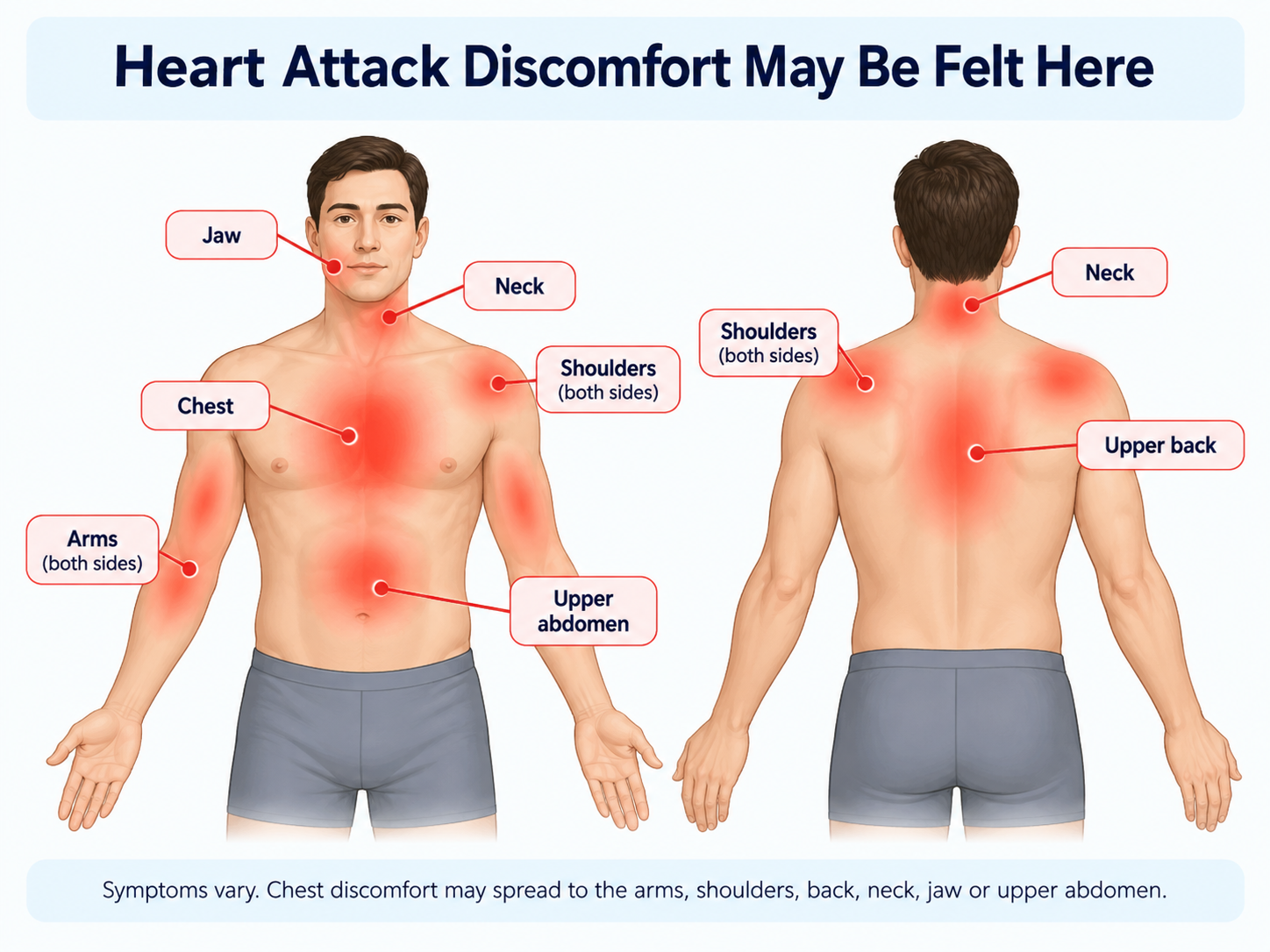 Medical infographic showing heart attack discomfort areas including the chest, both arms, shoulders, neck, jaw, upper back and upper abdomen.